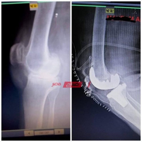 مستشفى دمياط العام تجري جراحة إستبدال مفصل ركبه مريض بآخر صناعي لأول مرة