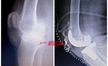 مستشفى دمياط العام تجري جراحة إستبدال مفصل ركبه مريض بآخر صناعي لأول مرة
