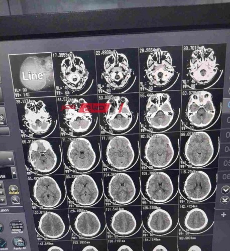 مستشفى دمياط العام تنقذ مصاب بنزيف في المخ على اثر حادث سير