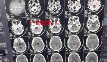 مستشفى دمياط العام تنقذ مصاب بنزيف في المخ على اثر حادث سير